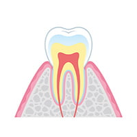脱灰 イメージ画像