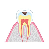 初期虫歯 イメージ画像
