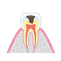 中等度虫歯 イメージ画像