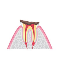 残根 イメージ画像