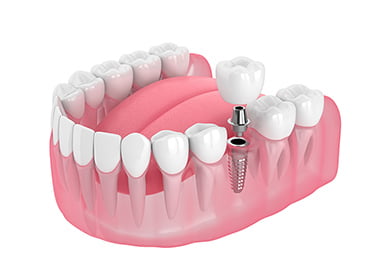 インプラント イメージ画像